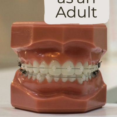 Getting Braces as an Adult